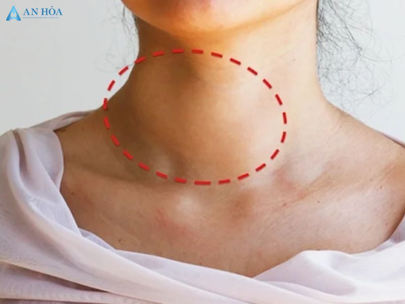 Những biểu hiện của ung thư tuyến giáp