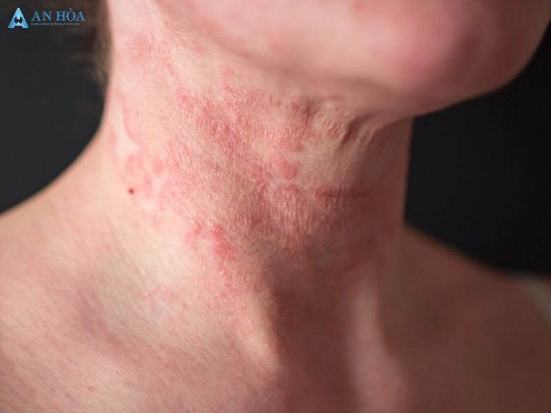 Những biểu hiện của ung thư tuyến giáp