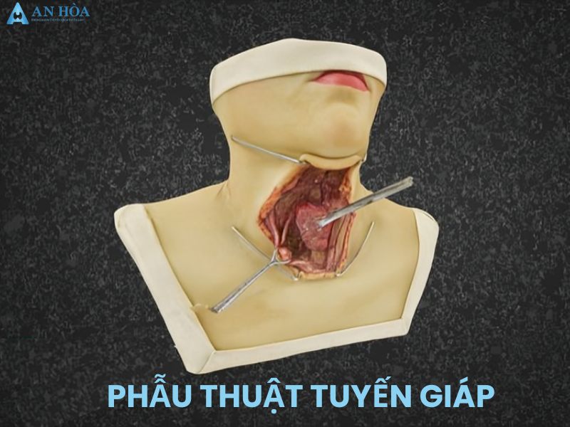 Chữa bệnh cường giáp