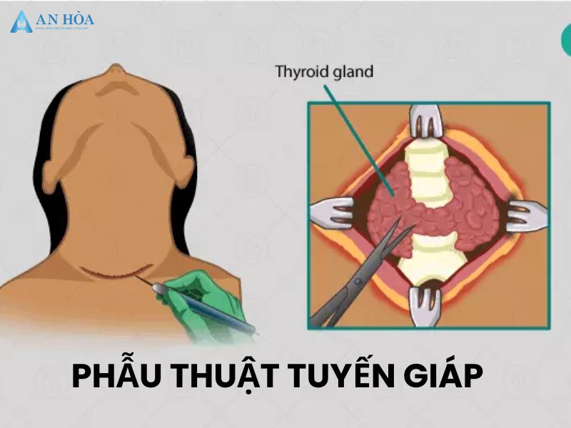 Điều trị K giáp