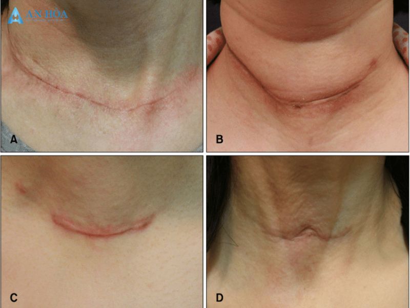 Điều trị K giáp