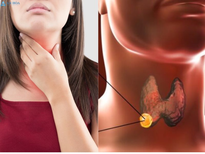 U ác tuyến giáp