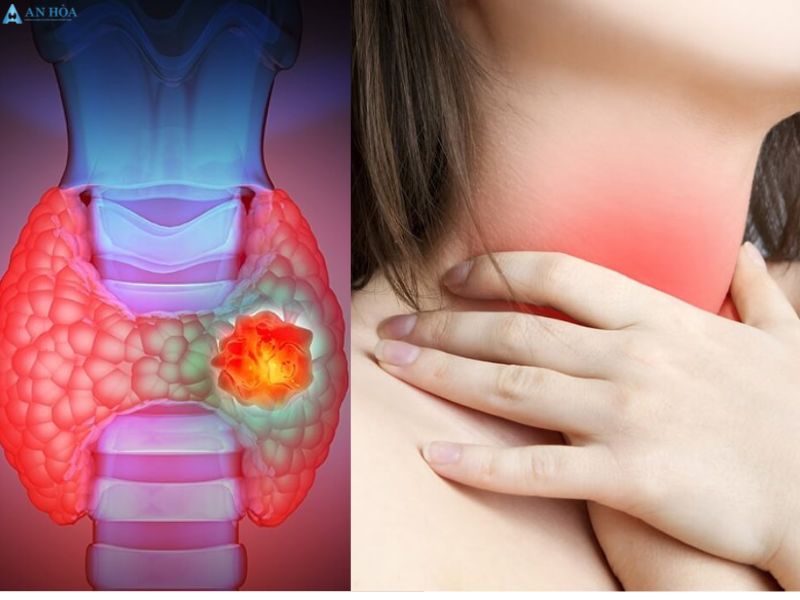 U tuyến giáp thể nang