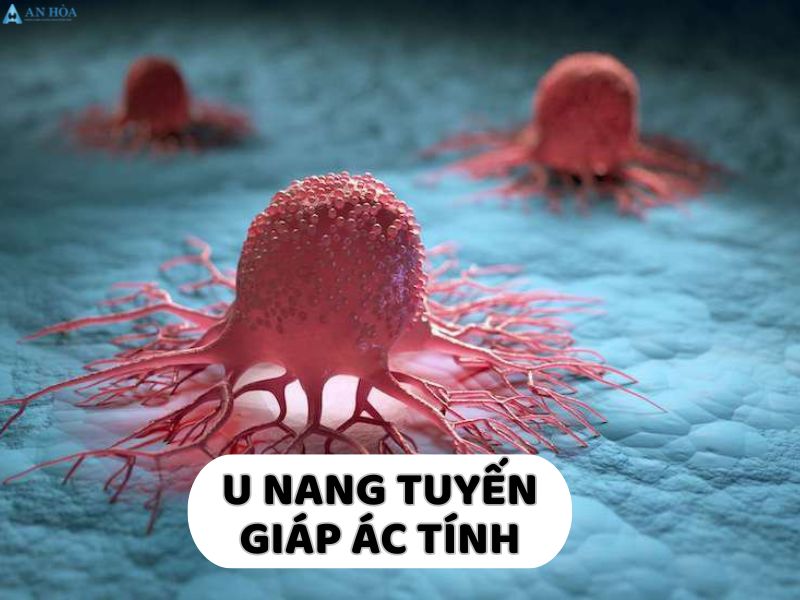 U tuyến giáp thể nang