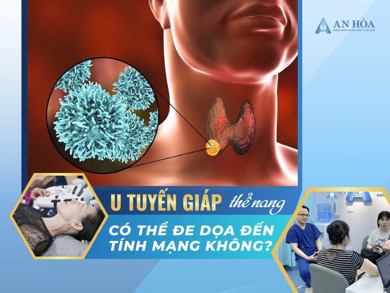 U tuyến giáp thể nang