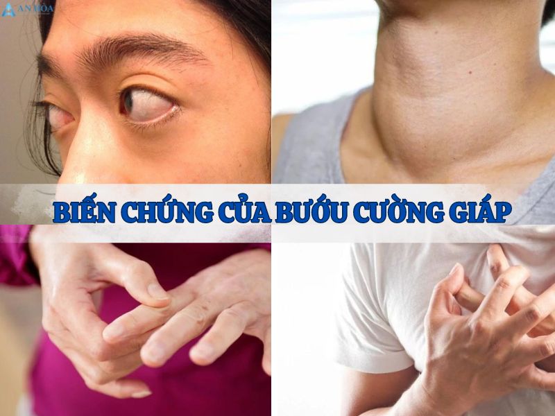 Bệnh bướu cường giáp