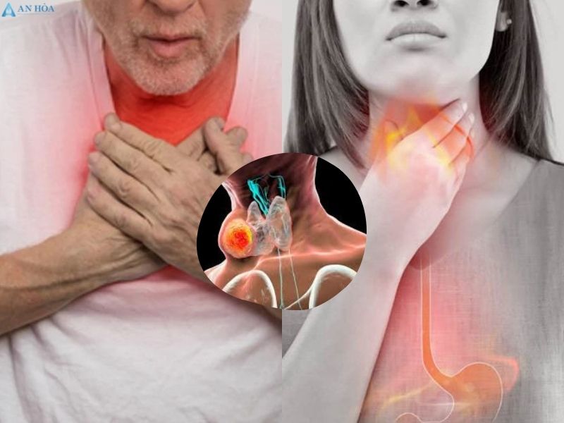 Bệnh bướu cường giáp
