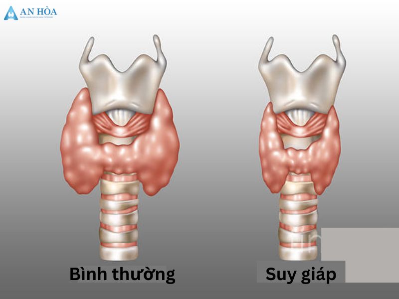 Bệnh tuyến giáp có chữa khỏi được không