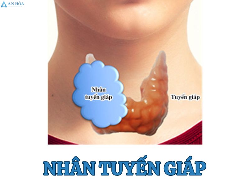 Có nhân ở tuyến giáp
