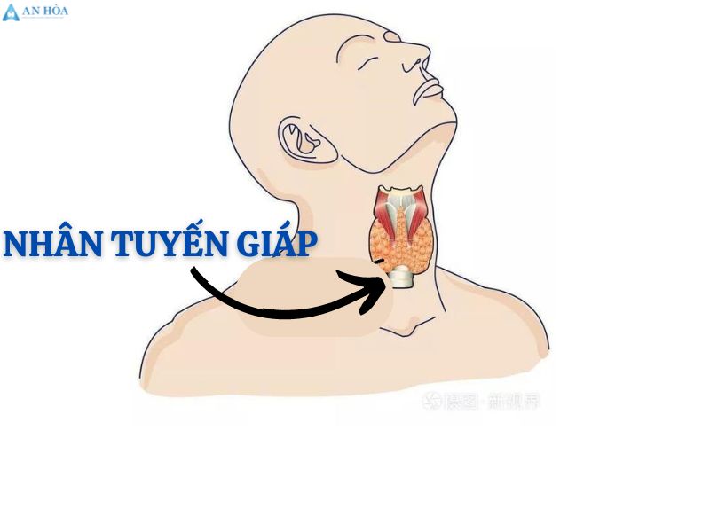 Có nhân ở tuyến giáp