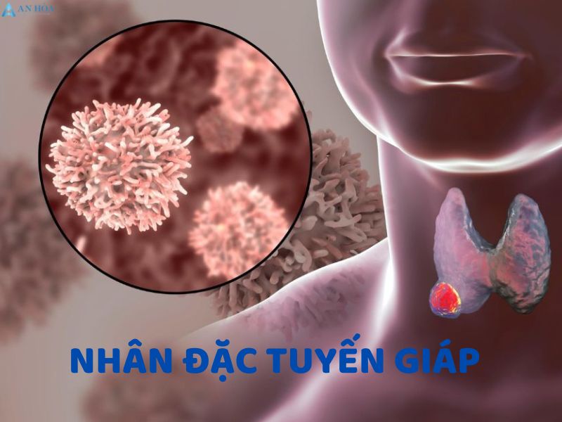 Nhân đặc tuyến giáp