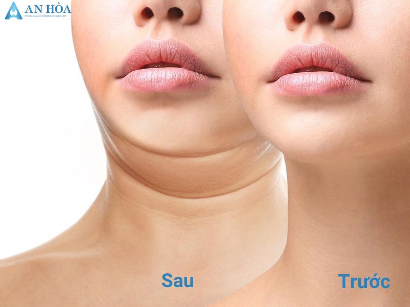 Những biểu hiện của bệnh tuyến giáp