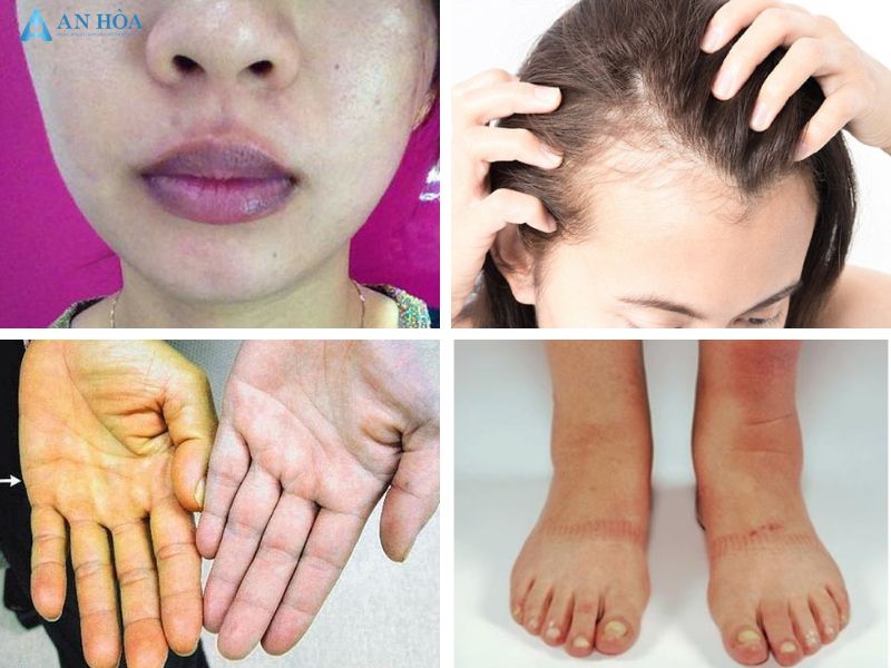 Triệu chứng của suy tuyến giáp