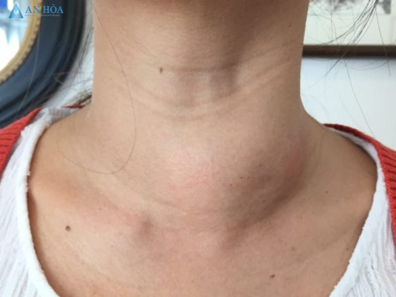 Triệu chứng của suy tuyến giáp