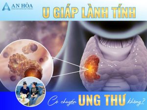 U giáp lành tính
