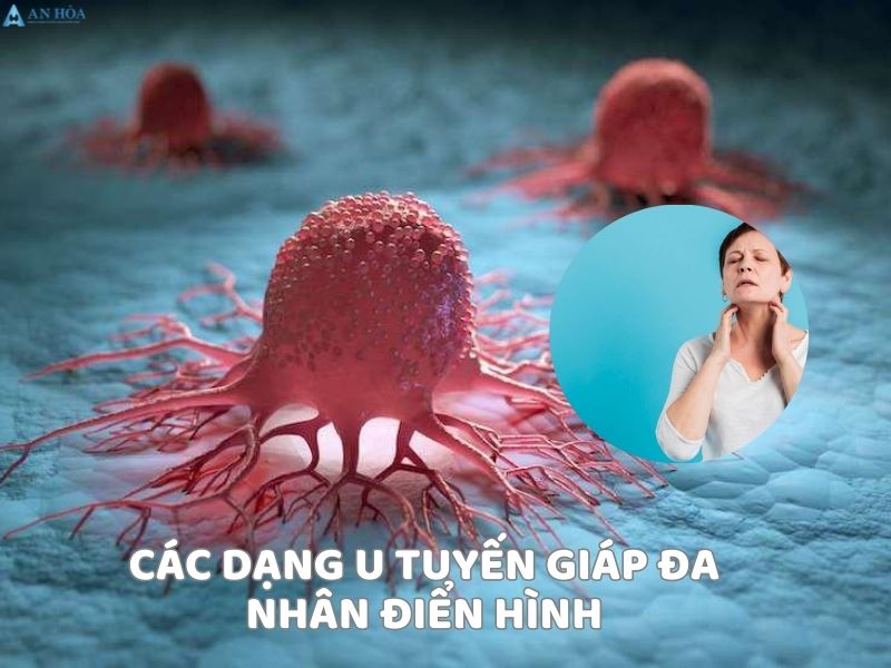 U hỗn hợp tuyến giáp
