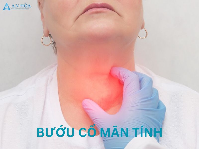 Bướu cổ mãn tính