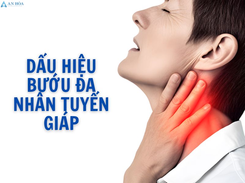 Bướu đa nhân tuyến giáp