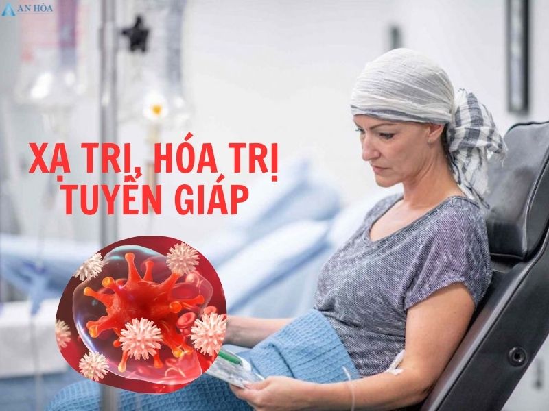 Điều trị u tuyến giáp ác tính