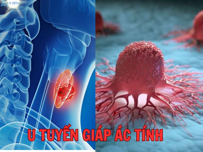 Điều trị u tuyến giáp ác tính
