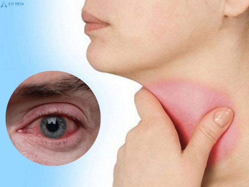 Nhân tuyến giáp ác tính