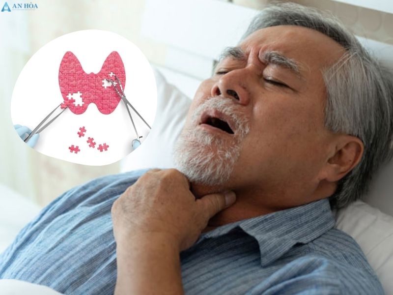 Bướu giáp đa nhân có nguy hiểm không