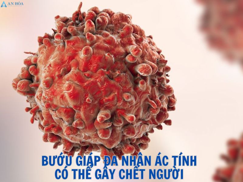 Bướu giáp đa nhân có nguy hiểm không