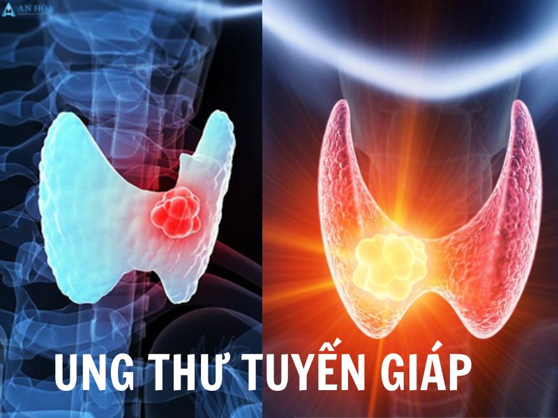 Cường giáp và ung thư tuyến giáp
